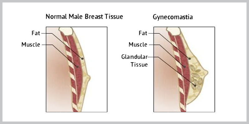 gynecomastia chest