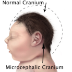 The cranium of a microcephalic infant.